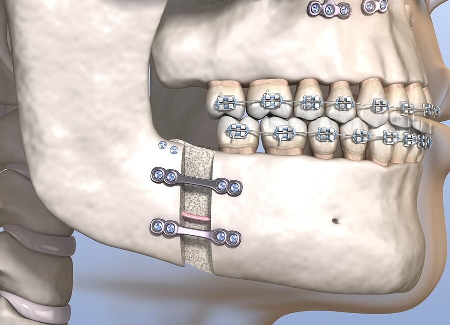 illustration of orthognathic surgery patient in Milwaukee WI