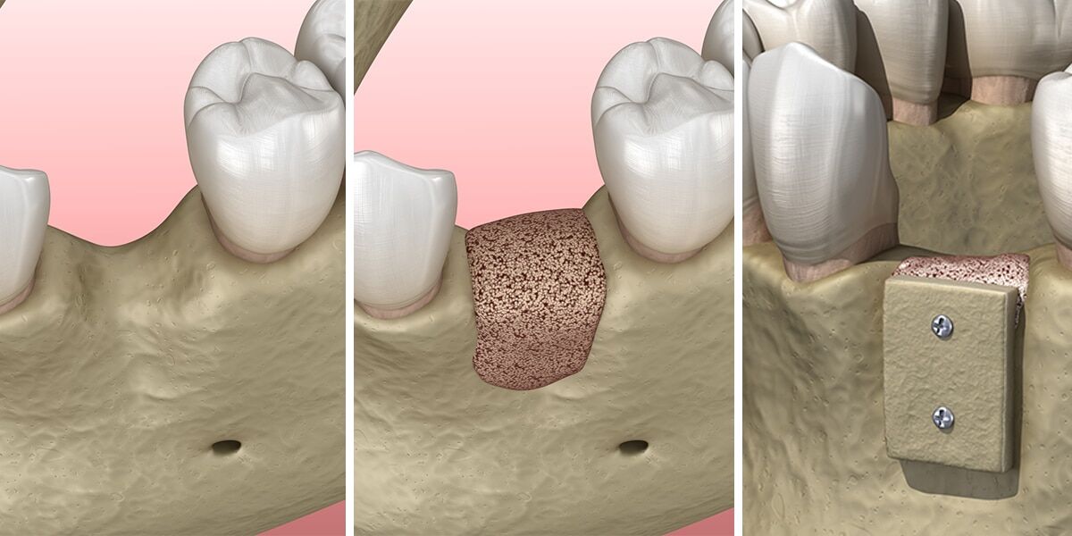 Jaw Bone Grafting for Dental Implants in Milwaukee WI